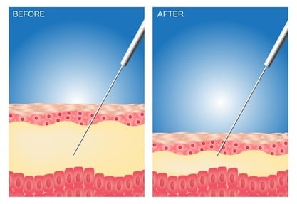 Liposuktion 